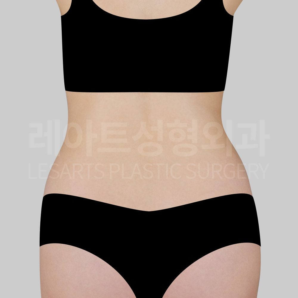 abdominal-liposuction-29200-before-back