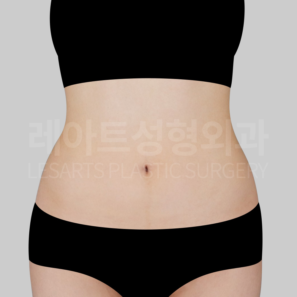 abdominal-liposuction-29200-before-front
