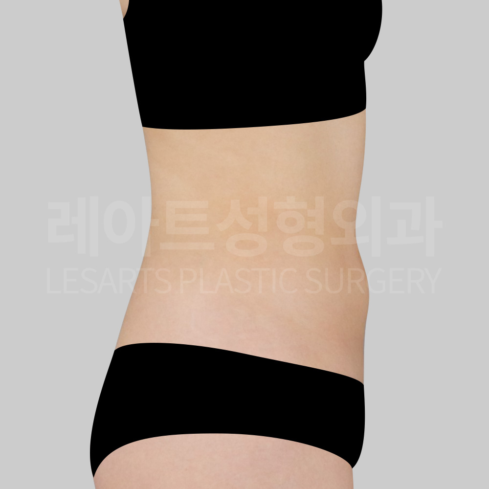 abdominal-liposuction-29200-before-side