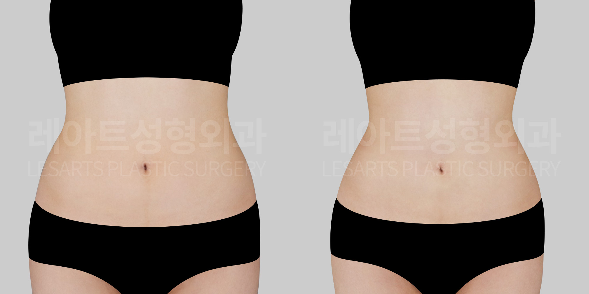 lesarts abdominal liposuction before and after
