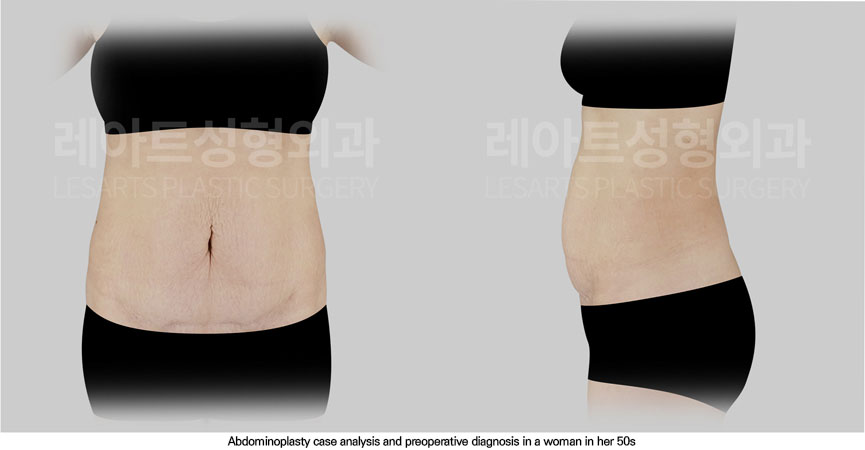 abdominoplasty-02-01-251114
