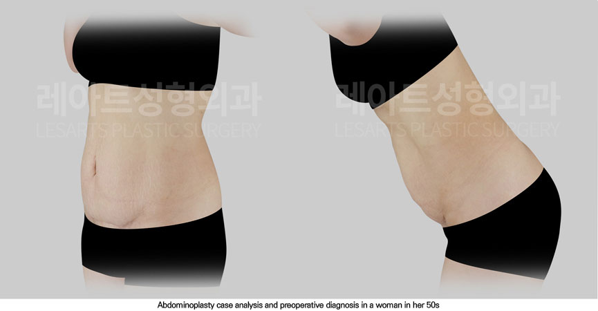 abdominoplasty-02-02-251114