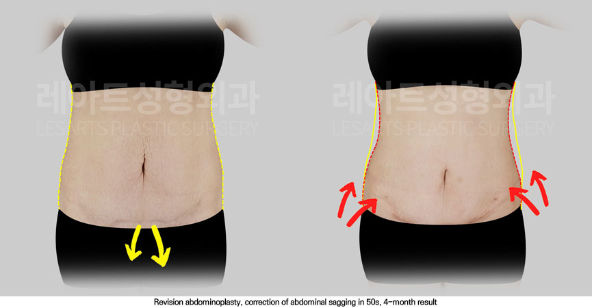 abdominoplasty-02-03-251114