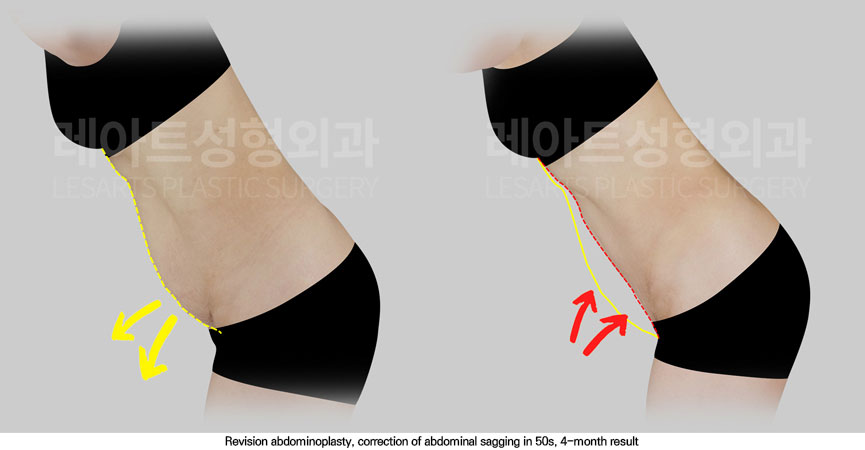 abdominoplasty-02-04-251114