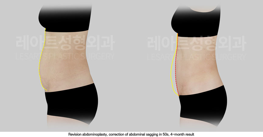 abdominoplasty-02-05-251114