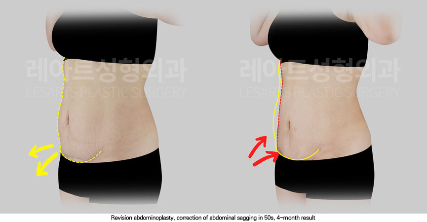 abdominoplasty-02-06-251114