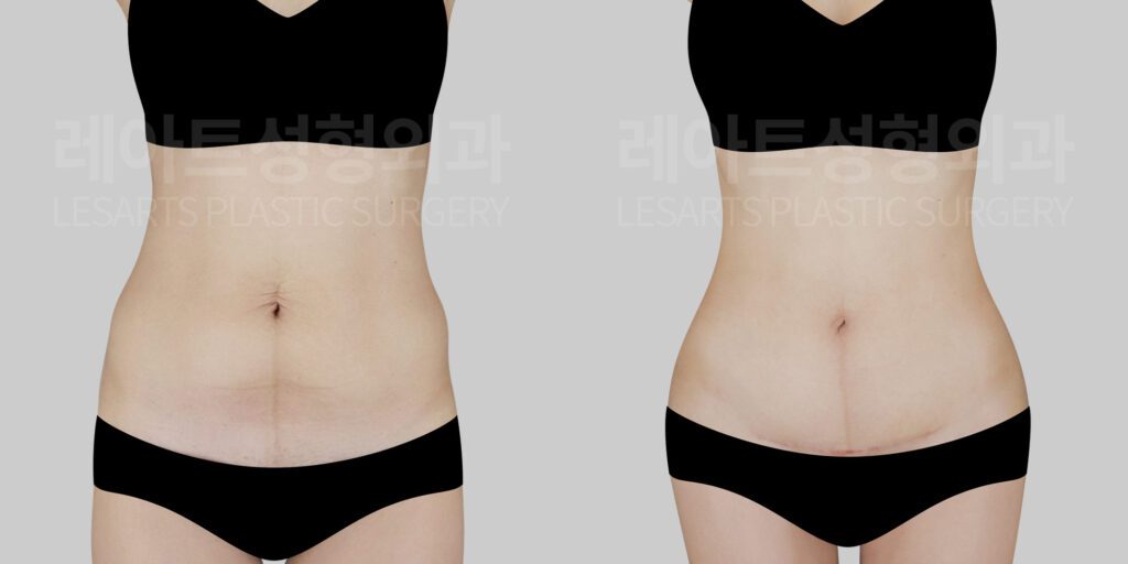 abdominoplasty before and after