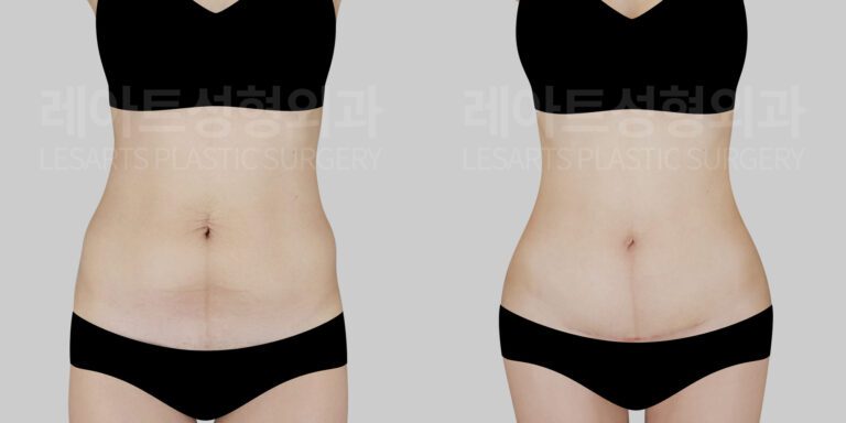 abdominoplasty before and after