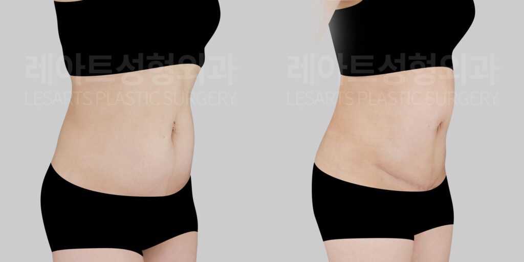 abdominoplasty with umbilical floating before and after