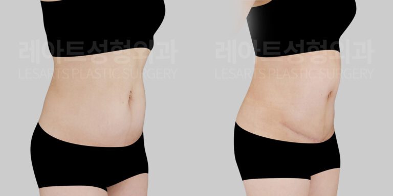 abdominoplasty with umbilical floating before and after