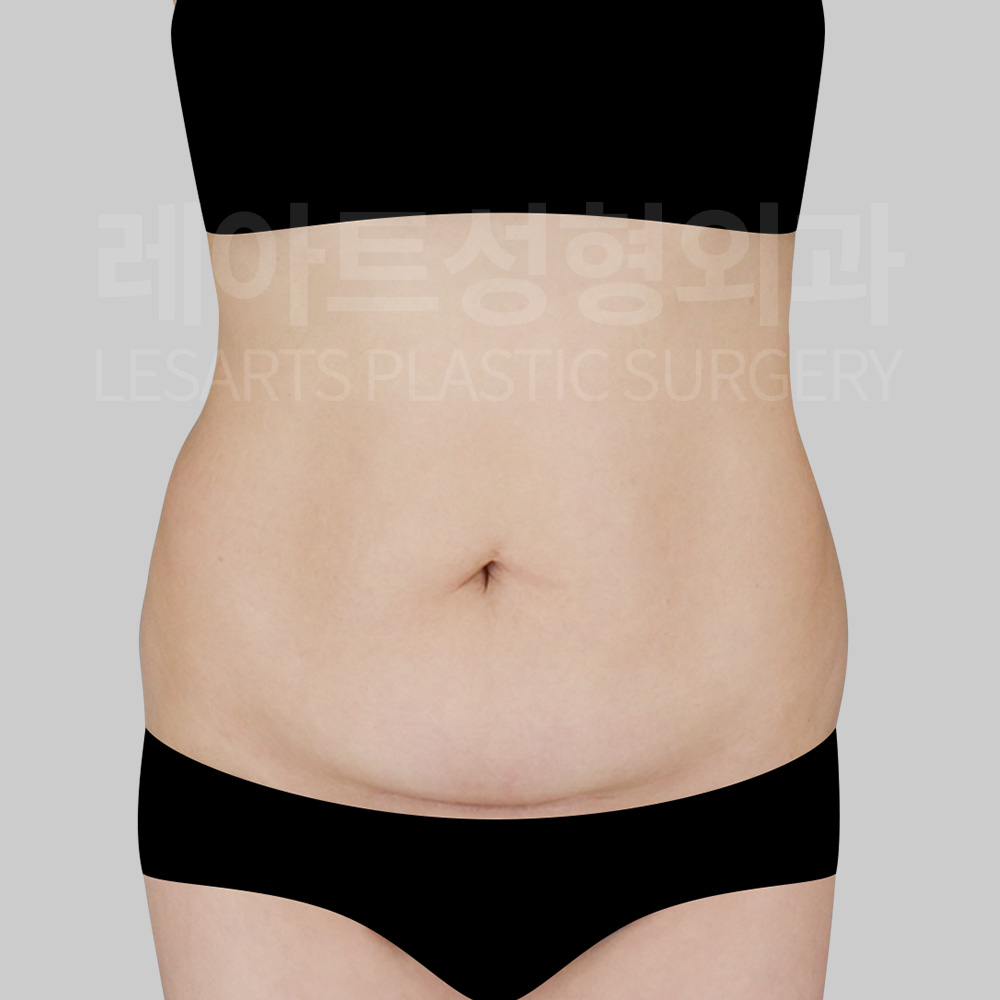 abdominoplasty-29972-before-front
