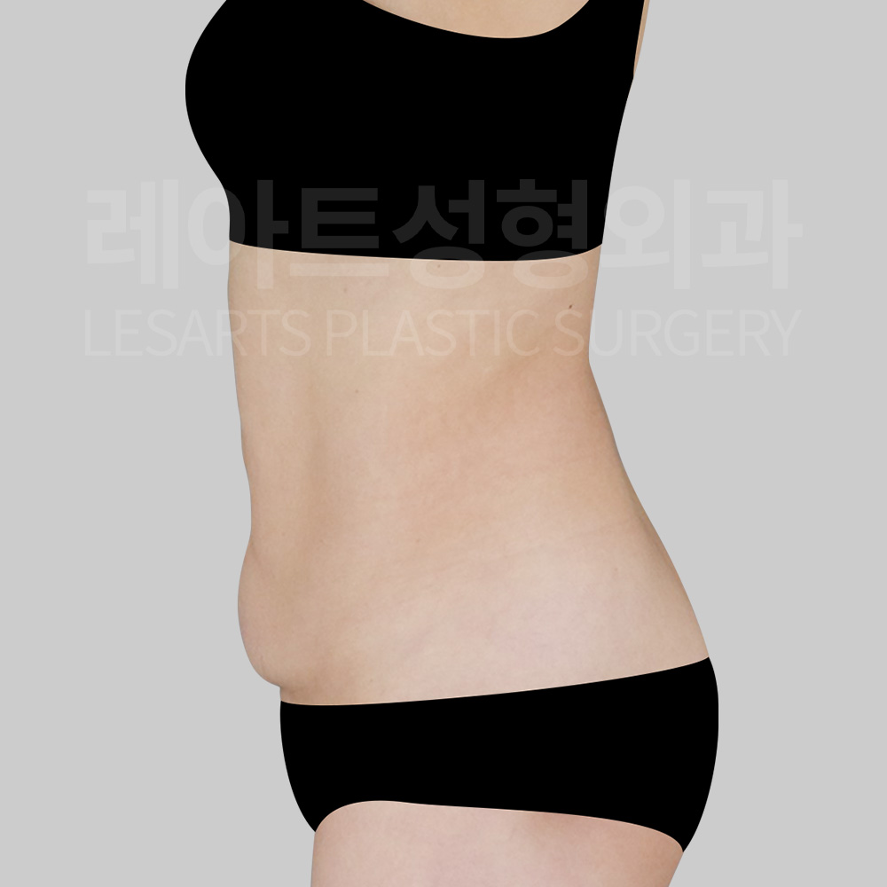 abdominoplasty-29972-before-side