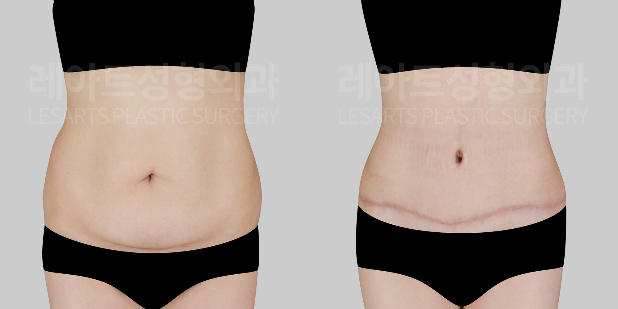 [Abdominoplasty] Skin indentation from cesarean scar improved with abdominoplasty