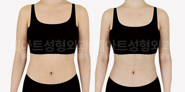 arm liposuction before and after(front)