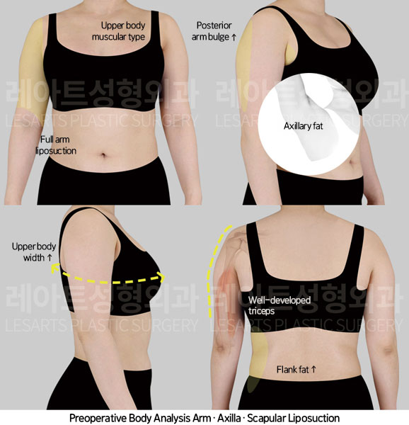 arm-liposuction-02-01-251104