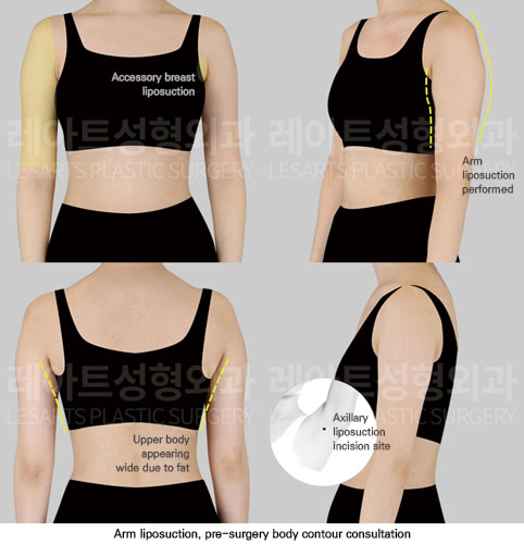 arm-liposuction-02-01-251112