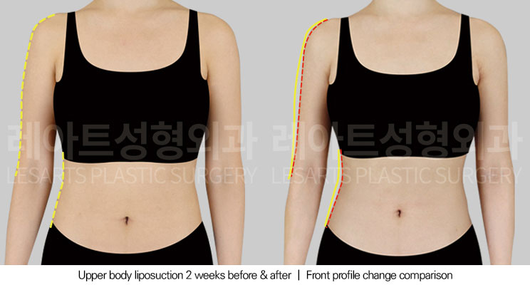 arm-liposuction-02-02-251029