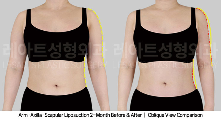 arm-liposuction-02-02-251104