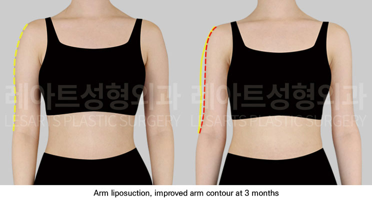 arm-liposuction-02-02-251112