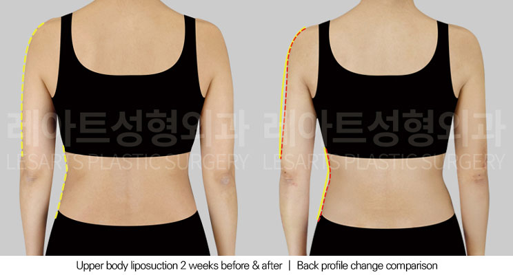 arm-liposuction-02-03-251029