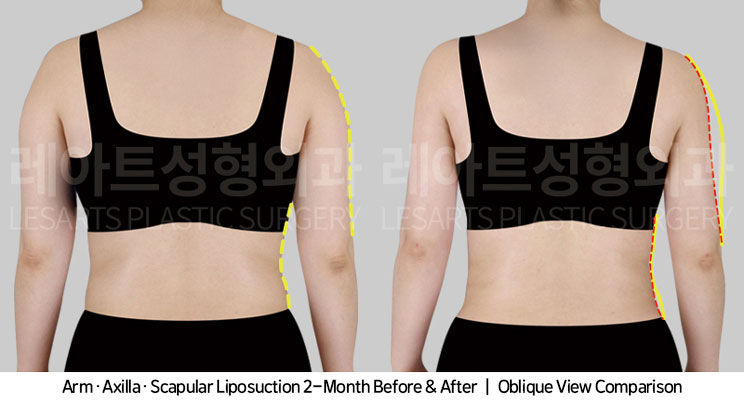 arm-liposuction-02-03-251104