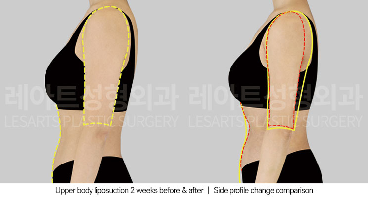 arm-liposuction-02-04-251029