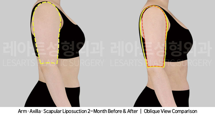 arm-liposuction-02-04-251104
