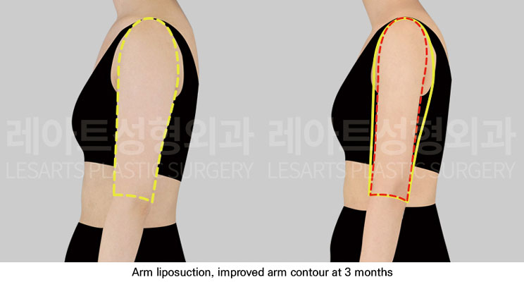 arm-liposuction-02-04-251112