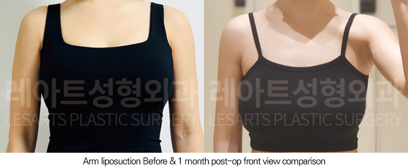 arm-liposuction-02-05-251029