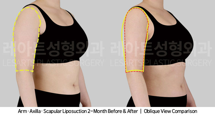 arm-liposuction-02-05-251104