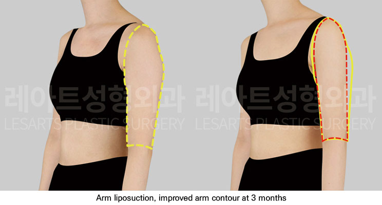 arm-liposuction-02-05-251112