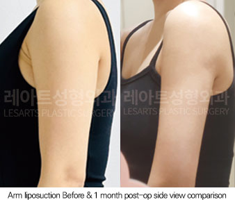 arm-liposuction-02-06-251029