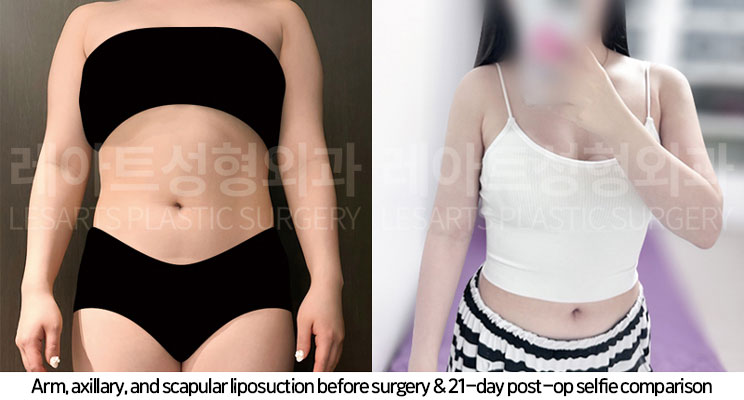 arm-liposuction-02-06-251104
