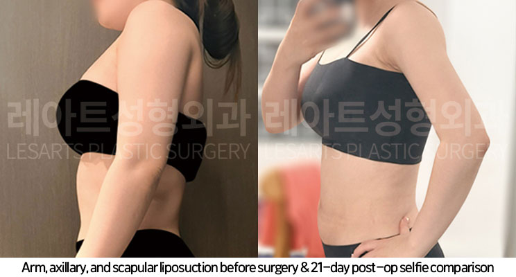 arm-liposuction-02-07-251104