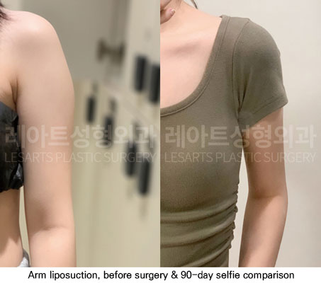 arm-liposuction-02-07-251112