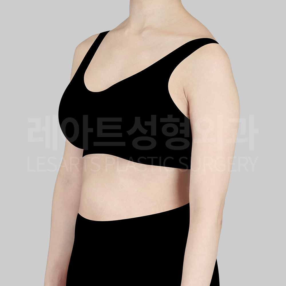 arm-liposuction-22260-before-45degree