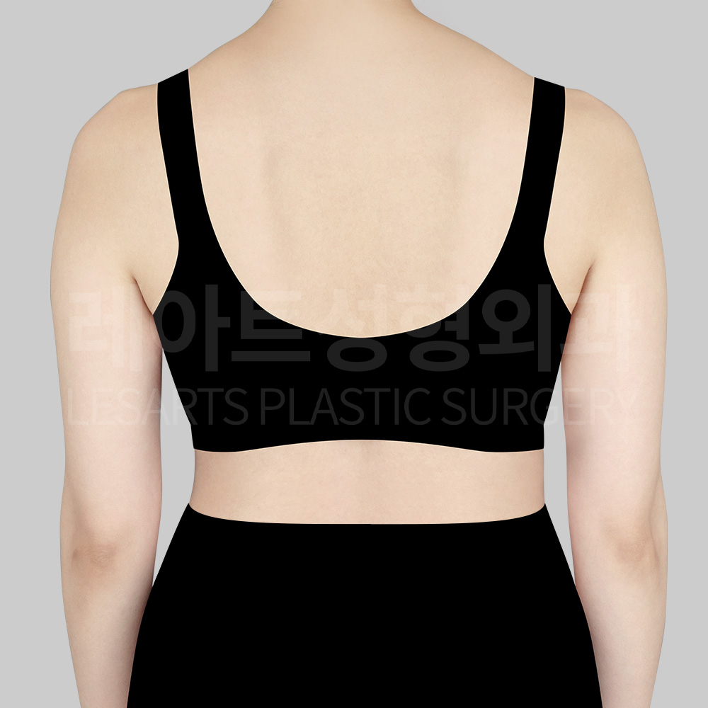 arm-liposuction-22260-before-back
