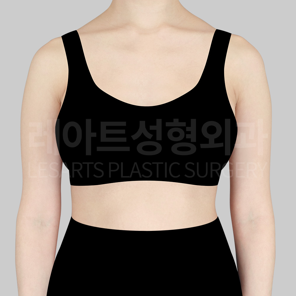 arm-liposuction-22260-before-front