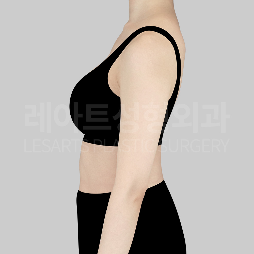 arm-liposuction-22260-before-side