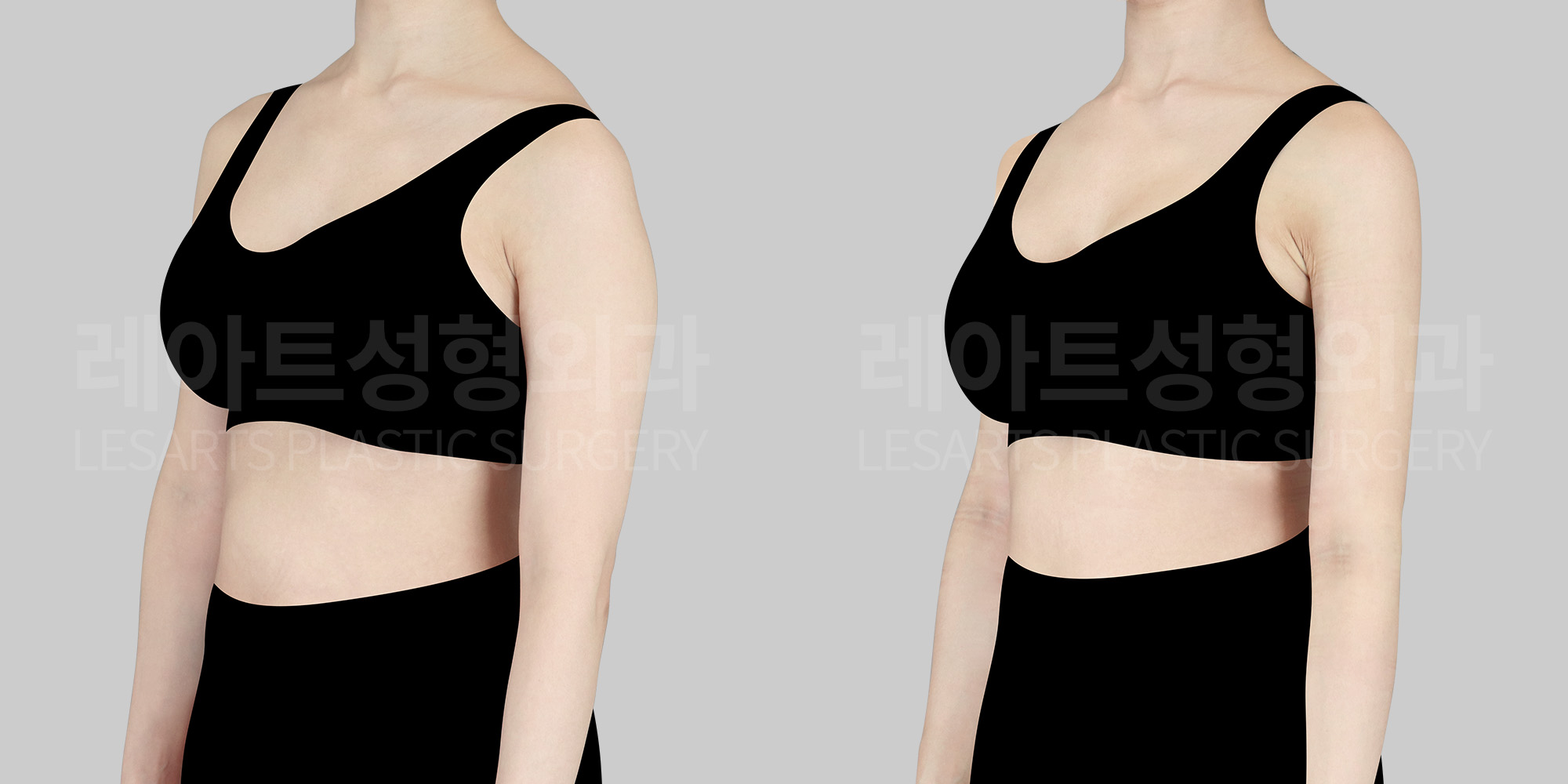 [Arm Liposuction] The First Noticeable Change in Before and After Photos of a Slim Body with Disproportionately Thick Arms