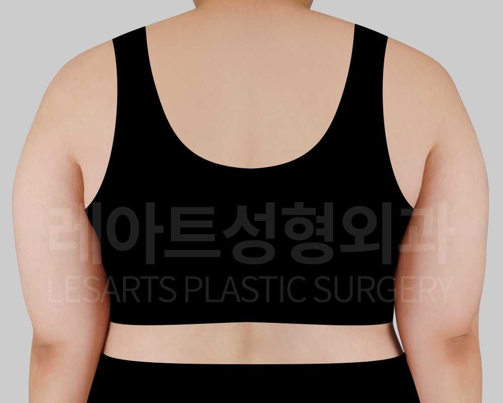 arm-liposuction-29647-before-back