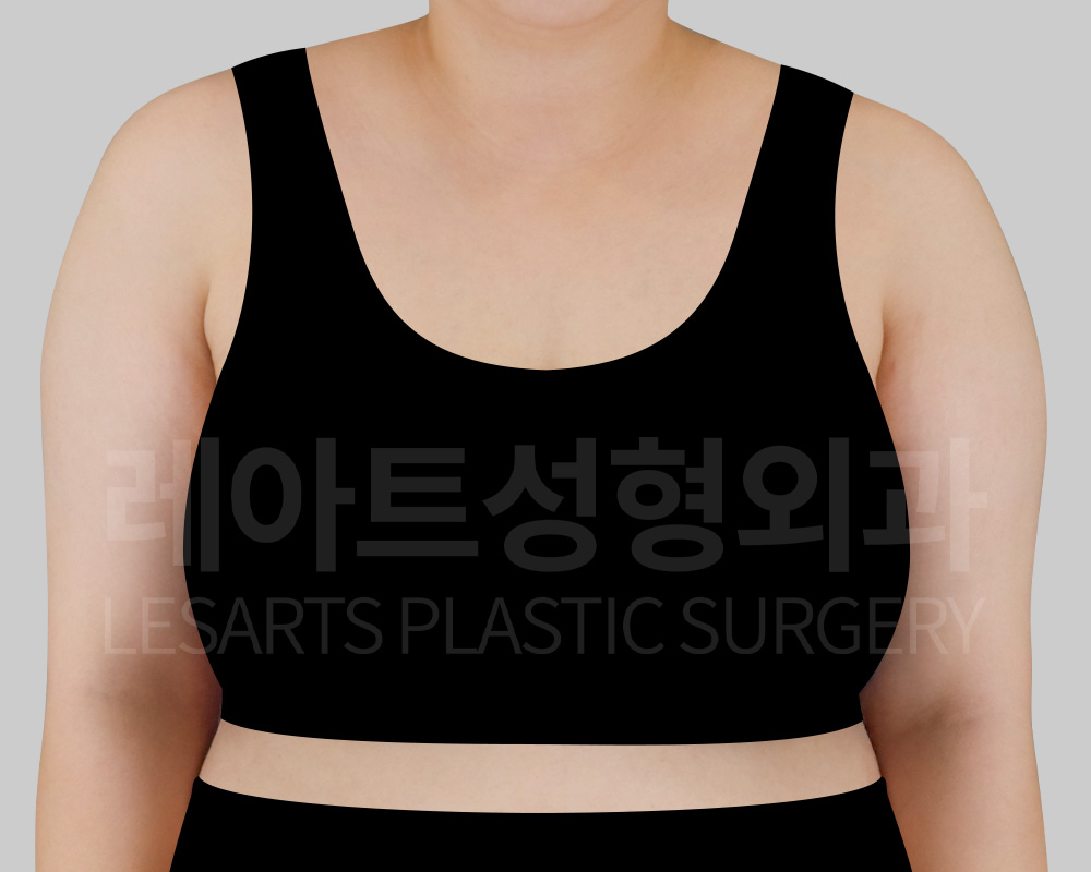 arm-liposuction-29647-before-front