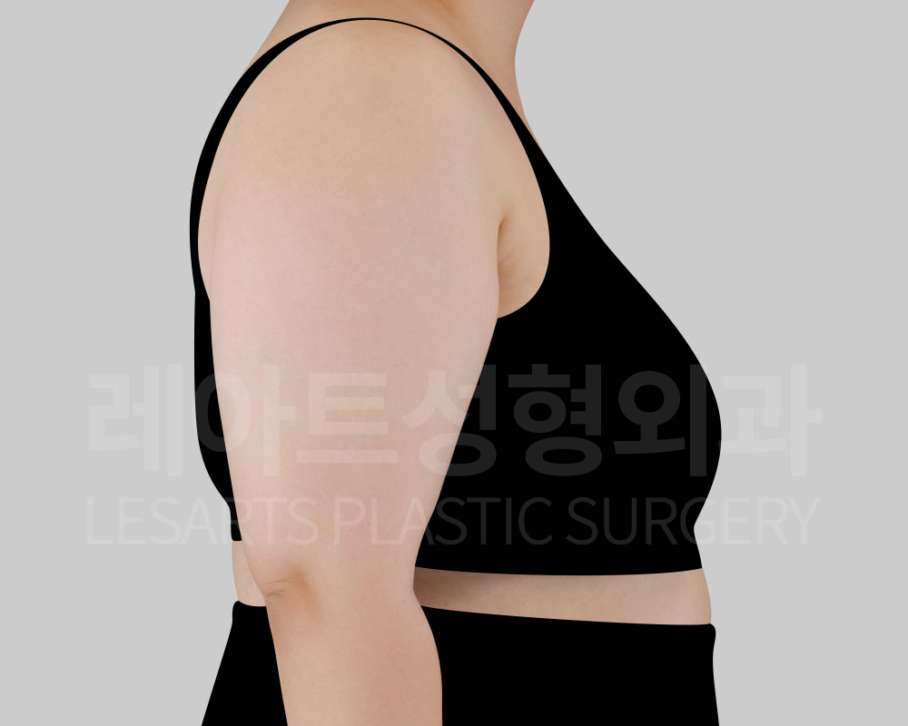 arm-liposuction-29647-before-side