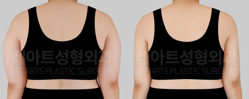 arm liposuction before and after(back view)