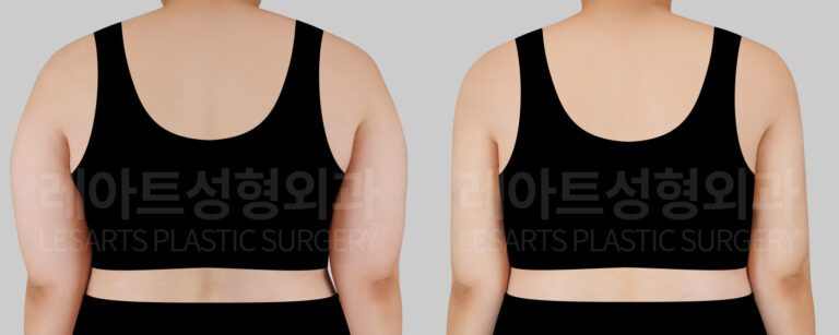 arm liposuction before and after(back view)