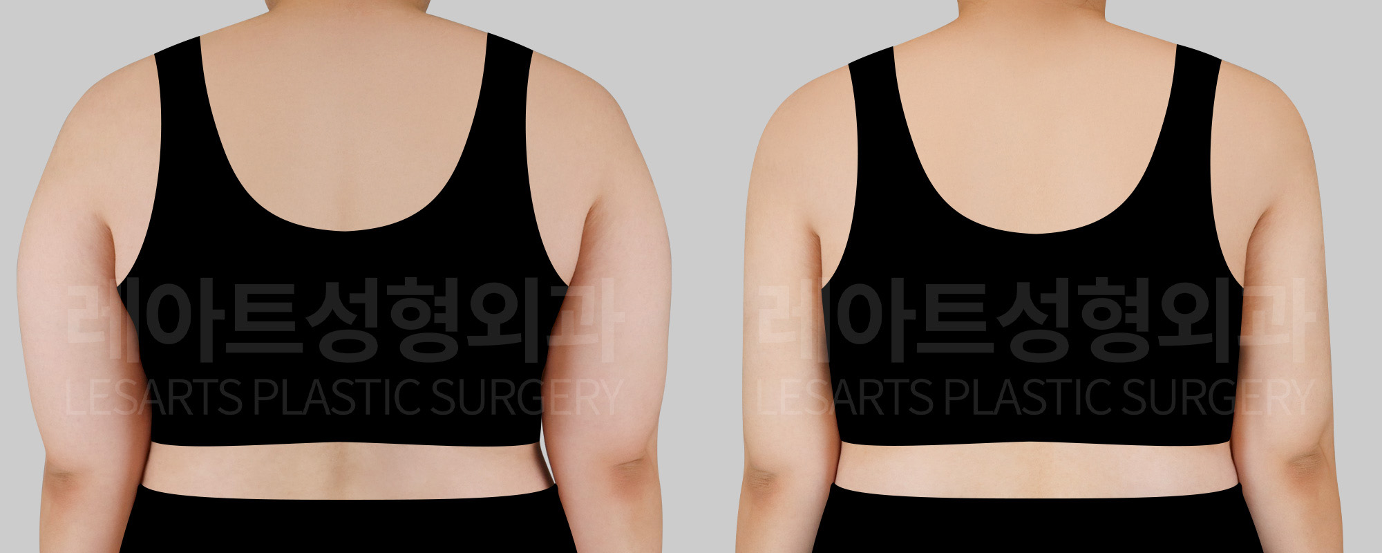 arm liposuction before and after(back view)