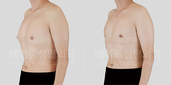 gynecomastia before and after
