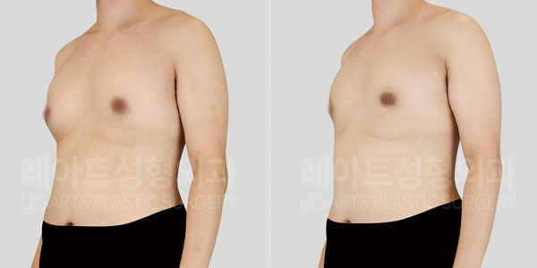 lesarts gynecomastia before and after