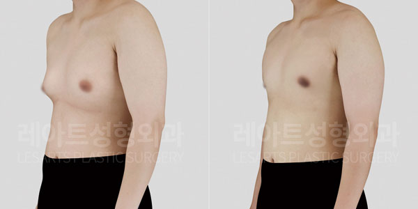 lesarts gynecomastia before and after