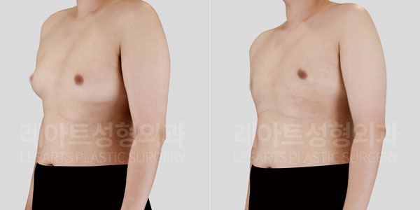 lesarts gynecomastia before and after